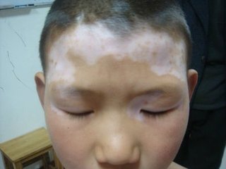 患白癜风的原因