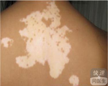 面部白癜风带来的心理负担
